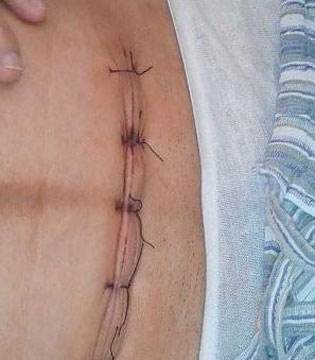 剖腹产刀口如何护理,剖腹产后刀口怎么护理