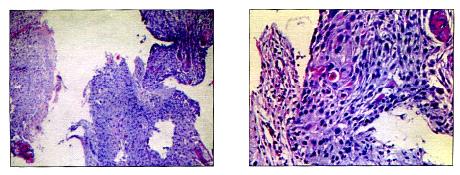 食管鳞状细胞癌病例解析