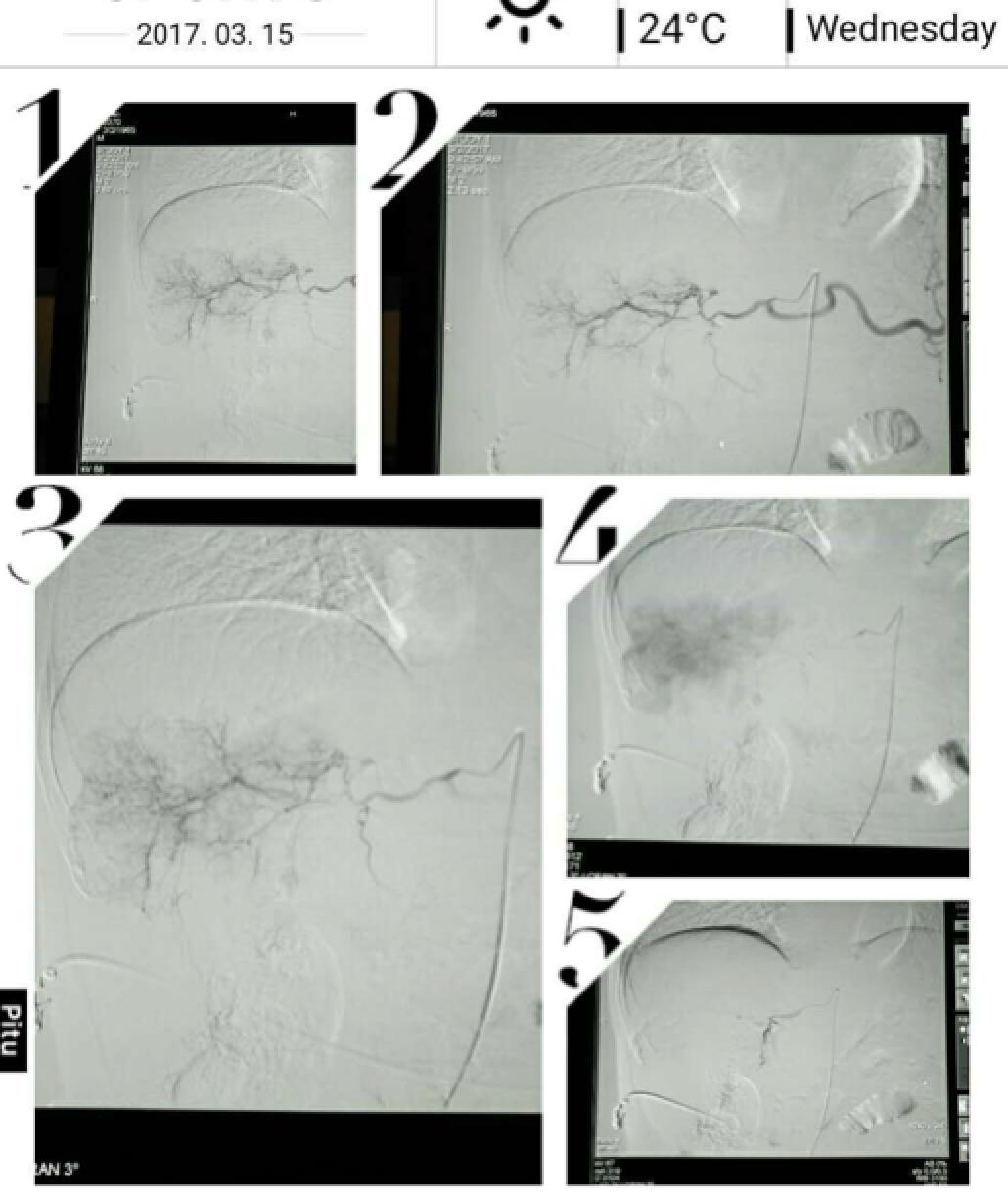 肝癌病例实例100例,肝癌的治疗方法论文