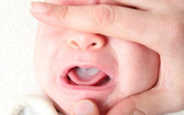 宝宝鹅口疮正确处理,宝宝鹅口疮严重最佳治疗方法