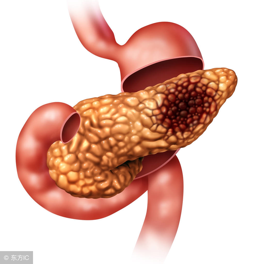 糖类抗原ca199指标高是什么原因,糖类抗原199ca199低了有问题吗