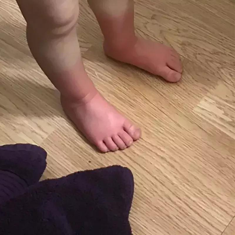 宝宝对净水器水过敏,对水过敏宝宝