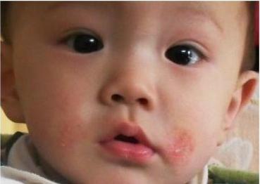 湿疹大作战全集,湿疹的治疗是一场持久战