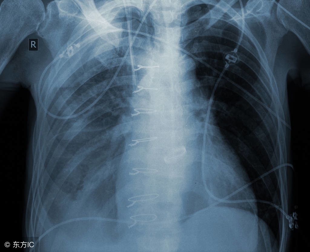 为什么中医治疗肺癌效果最好,中医对肺癌的治疗效果如何
