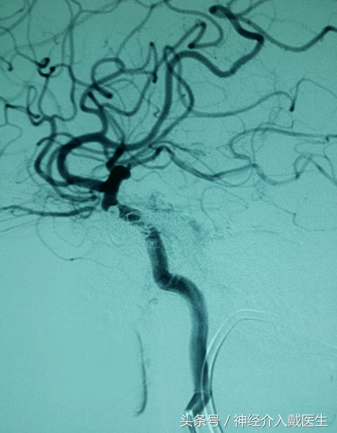 颅内高频声,听到颅内有咯噔声是什么原因
