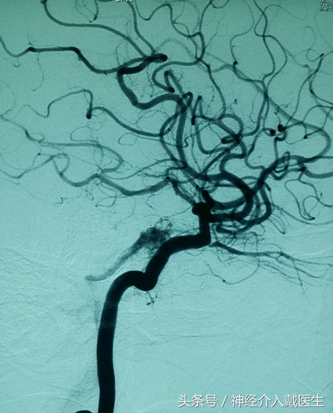颅内高频声,听到颅内有咯噔声是什么原因