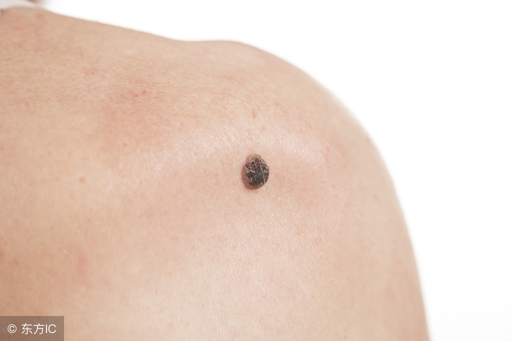 皮肤发硬要当回事，可能是皮肤癌征兆