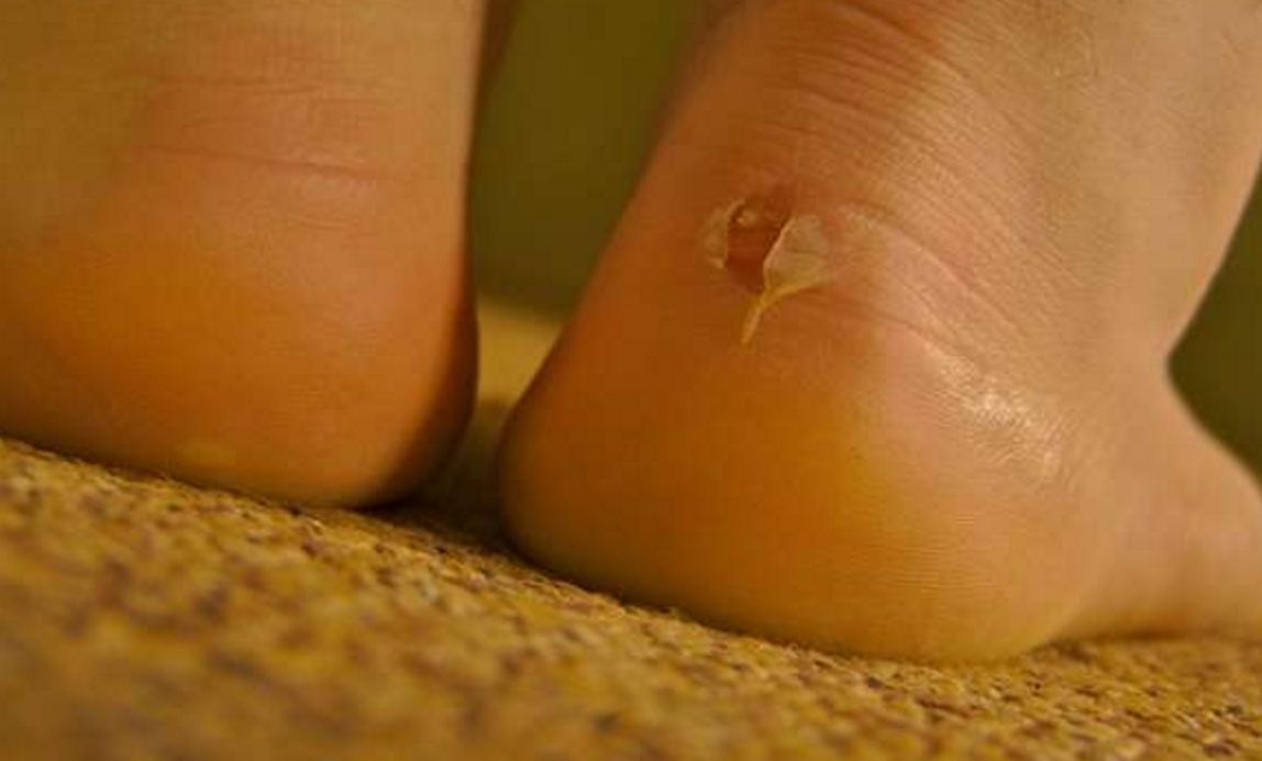 穿新鞋避免咬脚,不再破皮流血,保证让你像穿旧鞋那样舒服自在