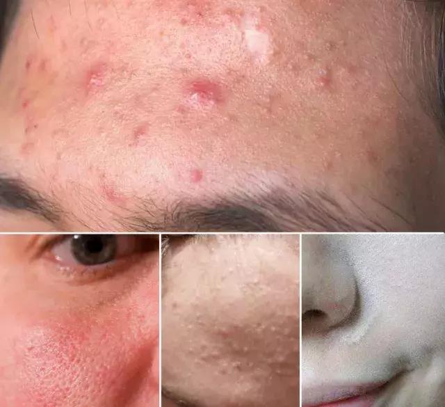 粉扑怎么消除细菌,清洗粉扑细菌