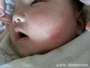 关于宝宝湿疹，宝妈一定要知道的