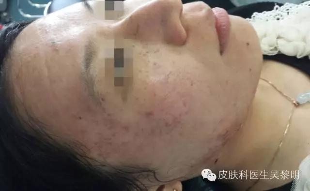 透明质酸护肤品功效,透明质酸是修复皮肤敏感成分