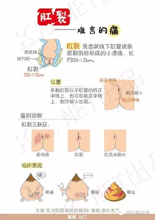 难以启齿的肛裂是怎么回事