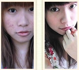 痘痘在哪几个地方不要挤掉,痘痘哪里不能挤