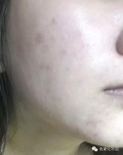 油皮痘肌适合的护肤品牌子,混油皮痘肌适用的护肤品推荐