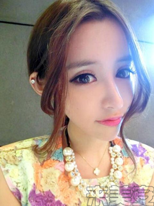 平行双眼皮割成了欧式双眼皮,割了个欧式双眼皮