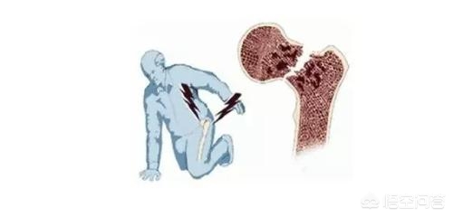 家里人摔骨折了去的时候带什么好,家里人骨折了谁来照顾