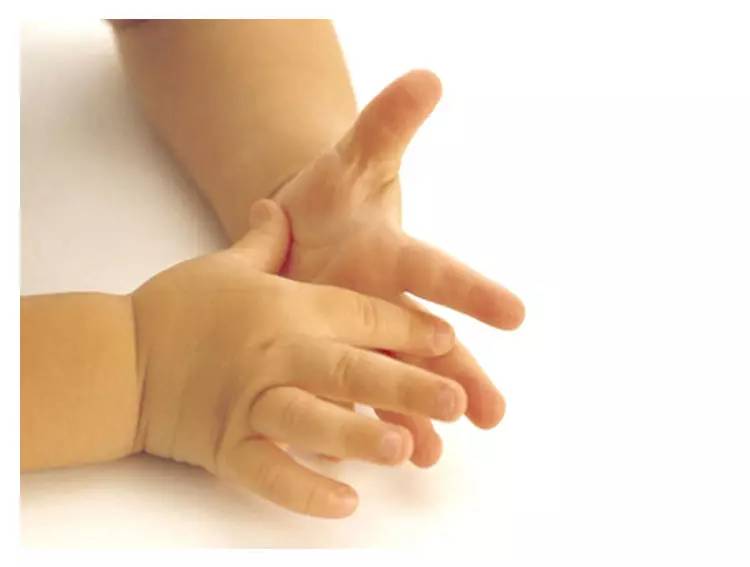 婴儿黄疸喂水能帮助退黄吗,30天的宝宝有黄疸怎么处理