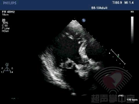 二尖瓣充血性囊肿,二尖瓣血性囊肿是什么意思