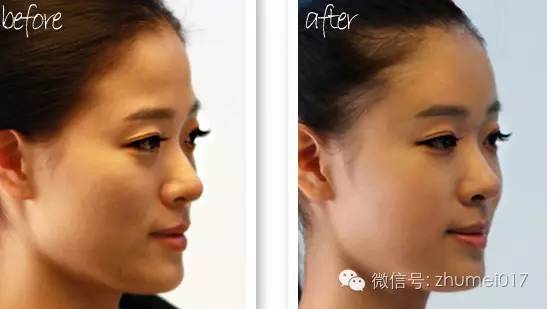 脸上部分凹陷,年龄增长脸颊凹陷