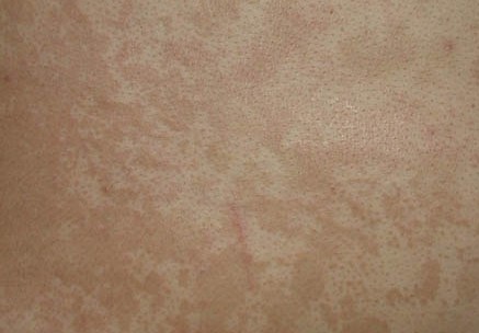 妙治汗斑的实用配方