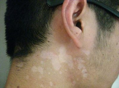 妙治汗斑的实用配方