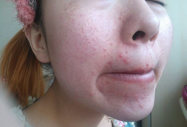 你的痘痘有救了吗,你的痘痘为什么那么难治