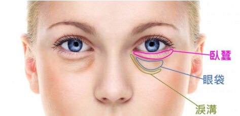 如何区分眼袋泪沟和卧蚕,如何区分眼袋和卧蚕泪沟