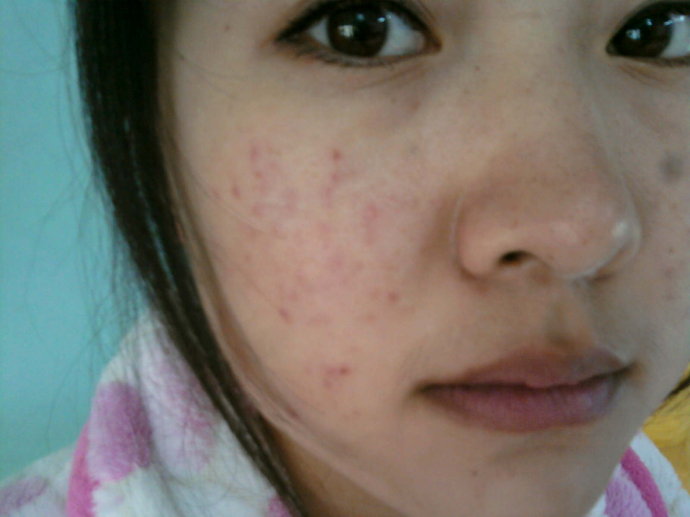 中药治疗激素依赖性皮炎,激素依赖性皮炎怎么治