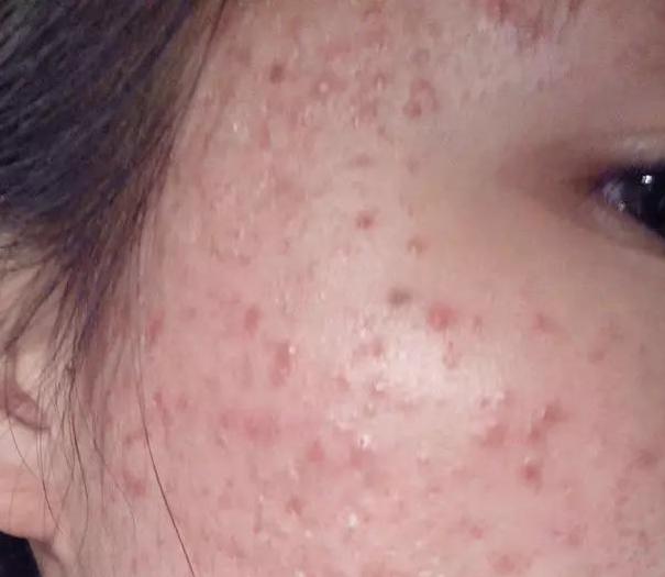 孕妇长痘痘消炎最快方法,孕妇怀孕脸上长痘痘怎么回事