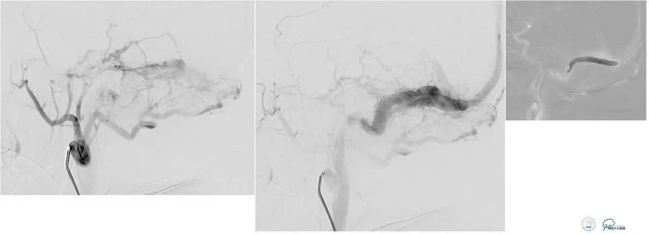 球囊辅助Onyx栓塞治疗硬脑膜动静脉瘘（DAVF）