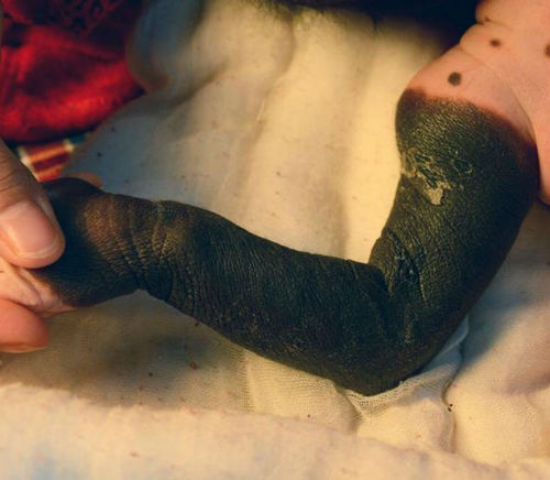 女婴患巨型兽皮痣,罕见病兽皮痣