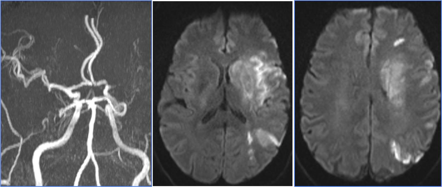 缺血性脑卒中术后管理,急性缺血性脑卒中血管内治疗