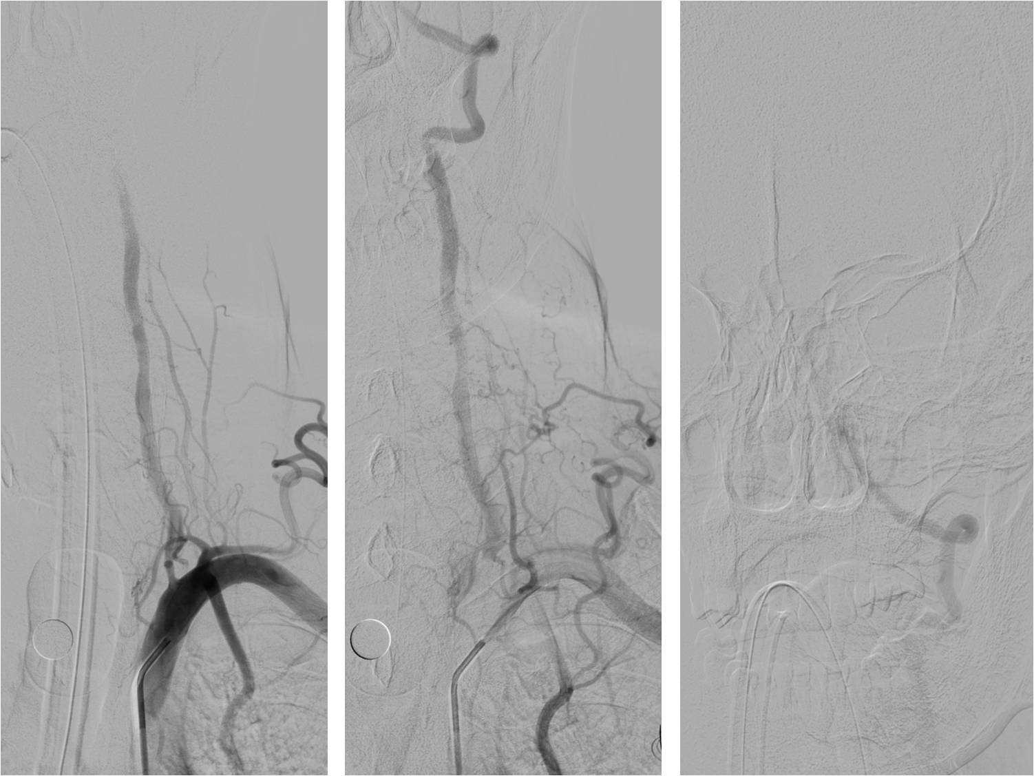 缺血性脑卒中术后管理,急性缺血性脑卒中血管内治疗