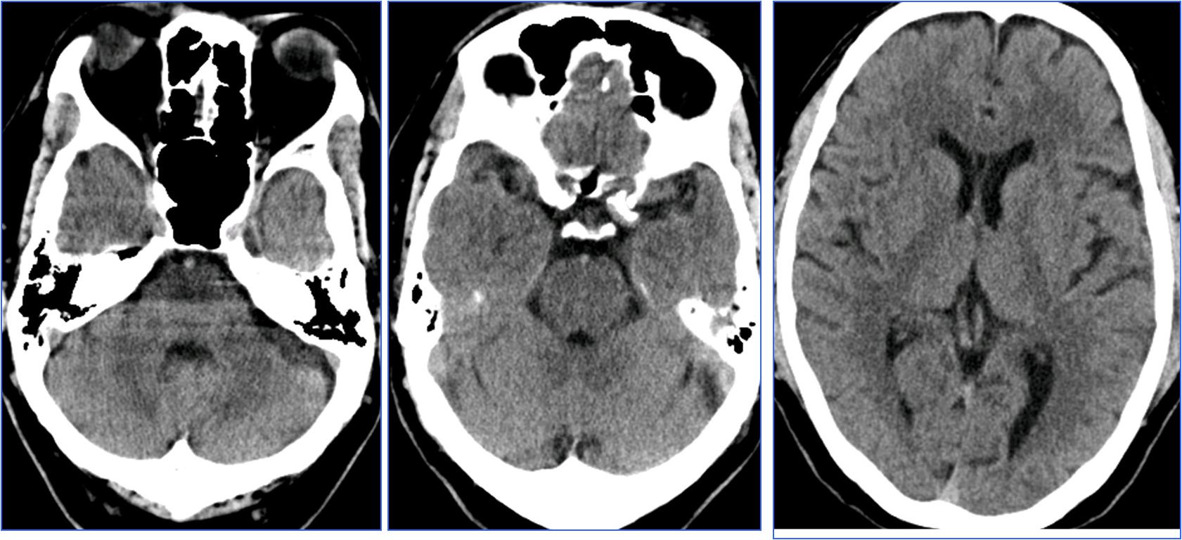 缺血性脑卒中术后管理,急性缺血性脑卒中血管内治疗