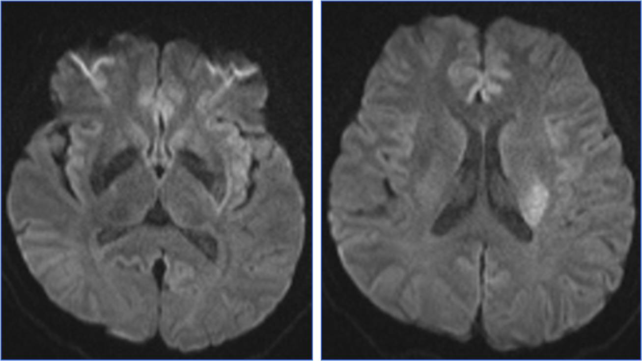 缺血性脑卒中术后管理,急性缺血性脑卒中血管内治疗