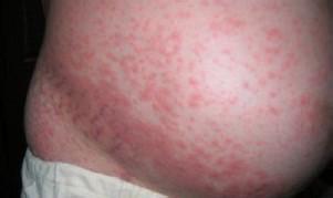 夏季如何防晒保护皮肤,孕妇要怎么护理皮肤