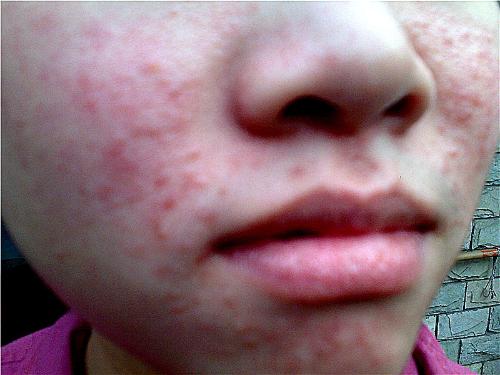 痘痘里面挤出来的白色东西是什么,闭合性粉刺挤出来白色有臭味