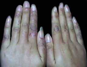 寒冬将至你该如何应对,冬天手冻疮怎么快速消除不用药膏