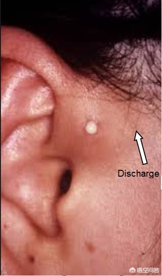 有些人耳朵有一个小洞,有的人耳朵上为什么有小洞洞