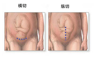 剖腹产没有想象中的那么可怕,剖腹产手术中的真实感受