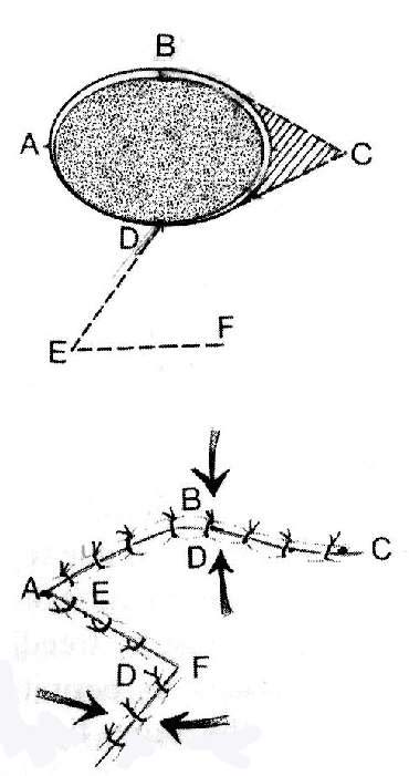 脸上有颗黑痣不去医院才能除掉,脸上黑痣不好去怎么办