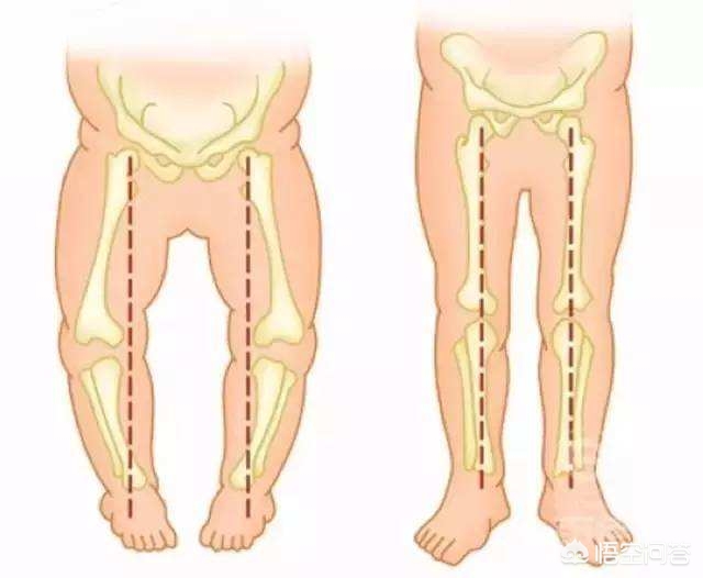 宝宝罗圈腿是天生的么,宝宝罗圈腿是什么原因引起的