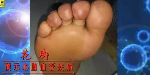 从脚看出疾病征兆,脚型不好看是怎么回事