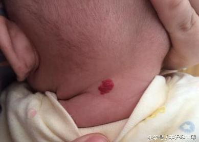 血管瘤：那些新生儿宝宝身上的红色的印记