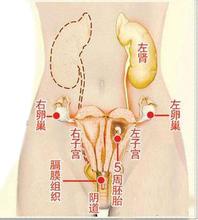 双子宫孕妇隔月生产,双子宫怀孕四胞胎