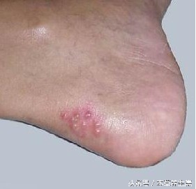 脚水泡又痒又脱皮糜烂怎么引起的,趾间糜烂型脚气可以用足光散吗