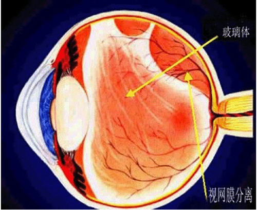 高度近视闪光感症状,闪光症是什么疾病的征兆