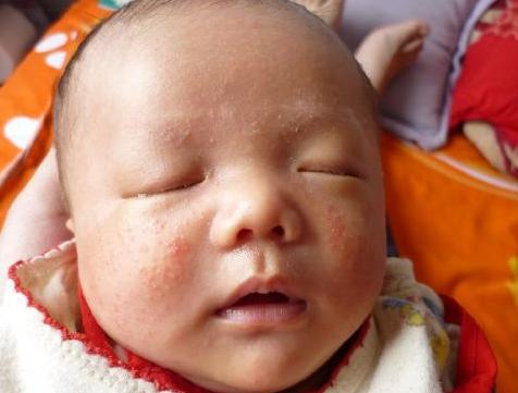 孩子身上起红疙瘩很痒什么情况,身上起红疙瘩还痒图片