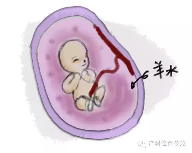 羊水过多和过少的原因,怎么预防羊水过多或过少