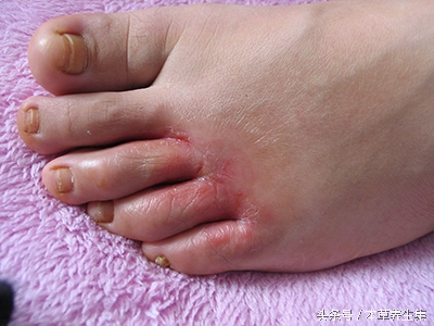 脚上脱皮红疱疹怎么根治,脚上反复起水泡脱皮开裂怎么治疗